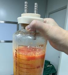 随州水动力吸脂手术要做多久？